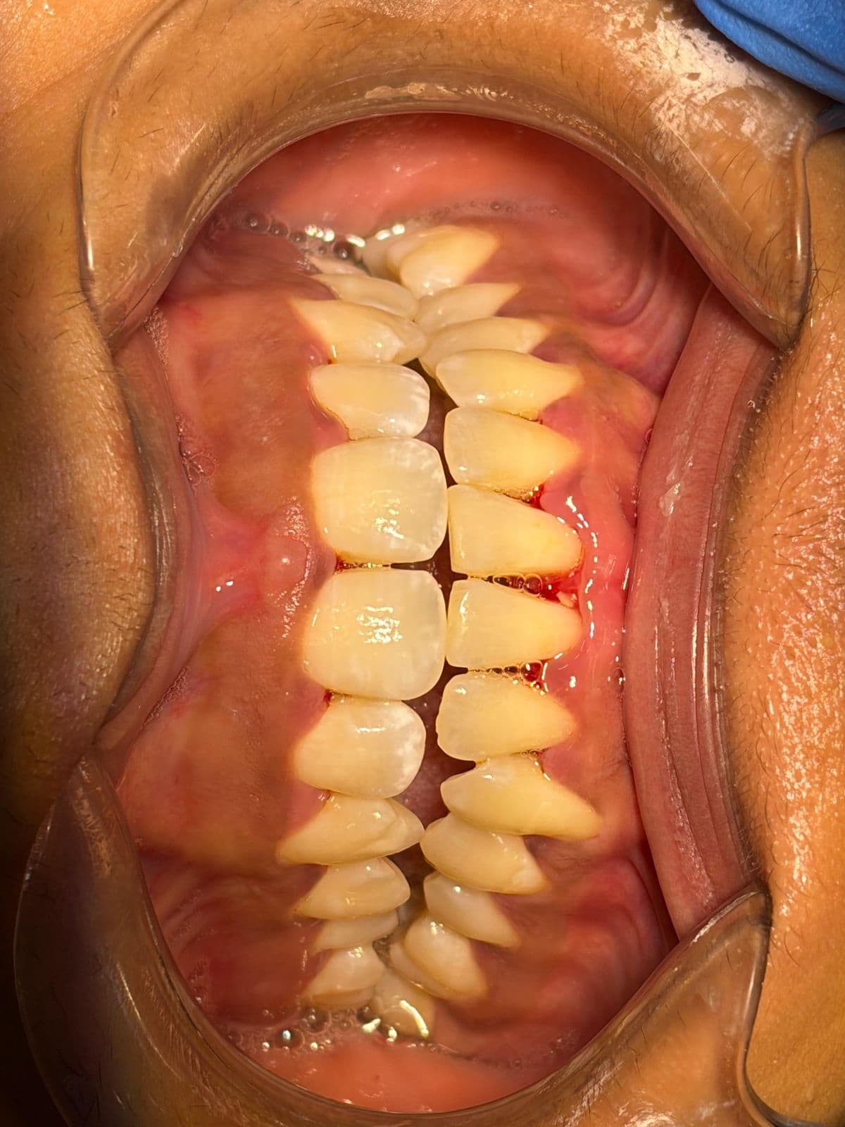 Scaling Prophylaxis — after