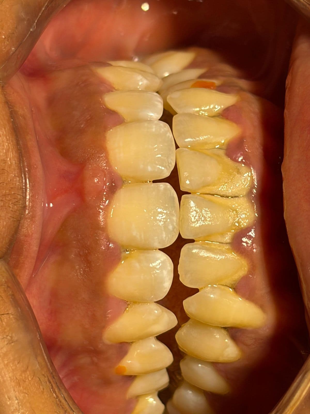 Scaling Prophylaxis — before