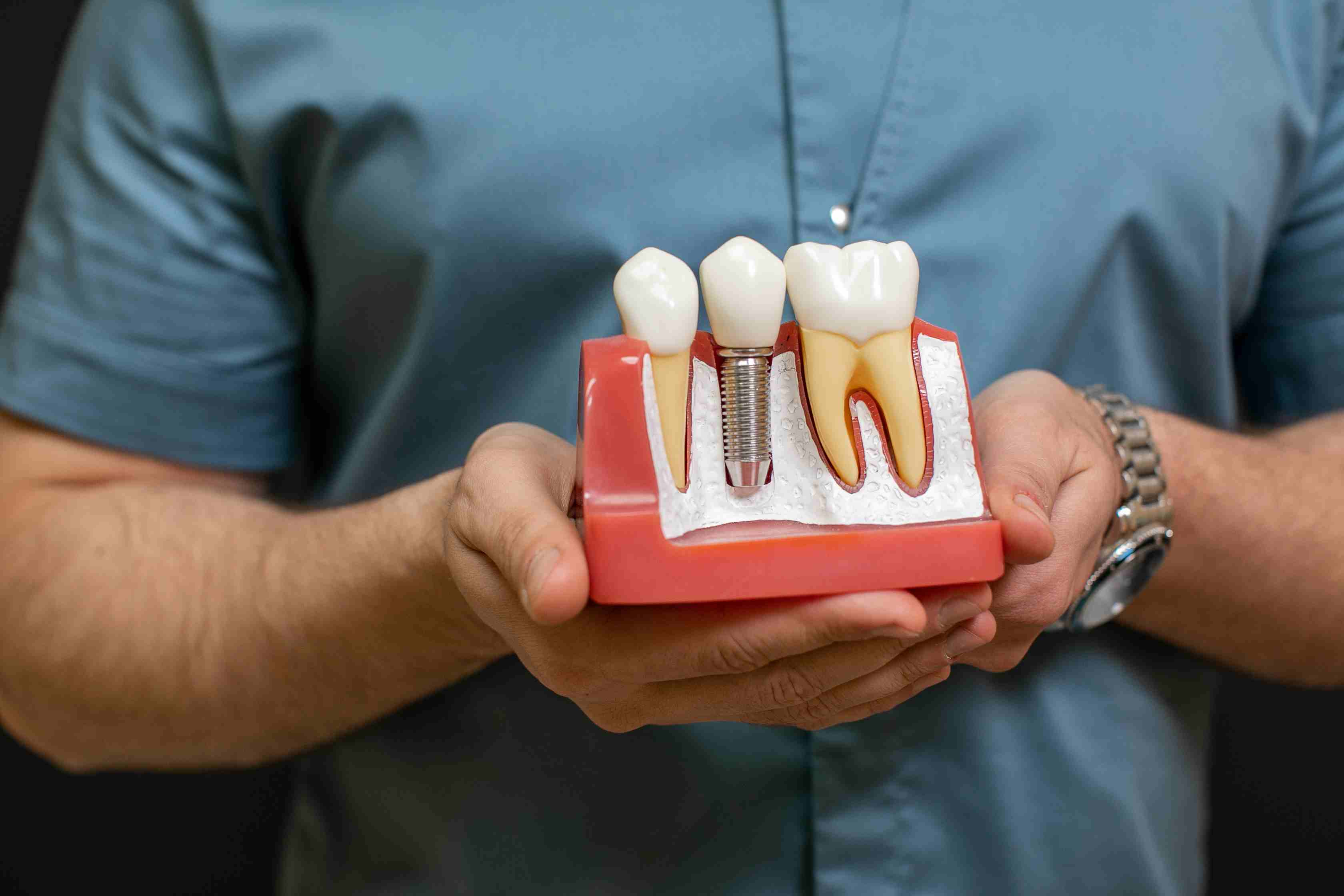 What are dental implants?
