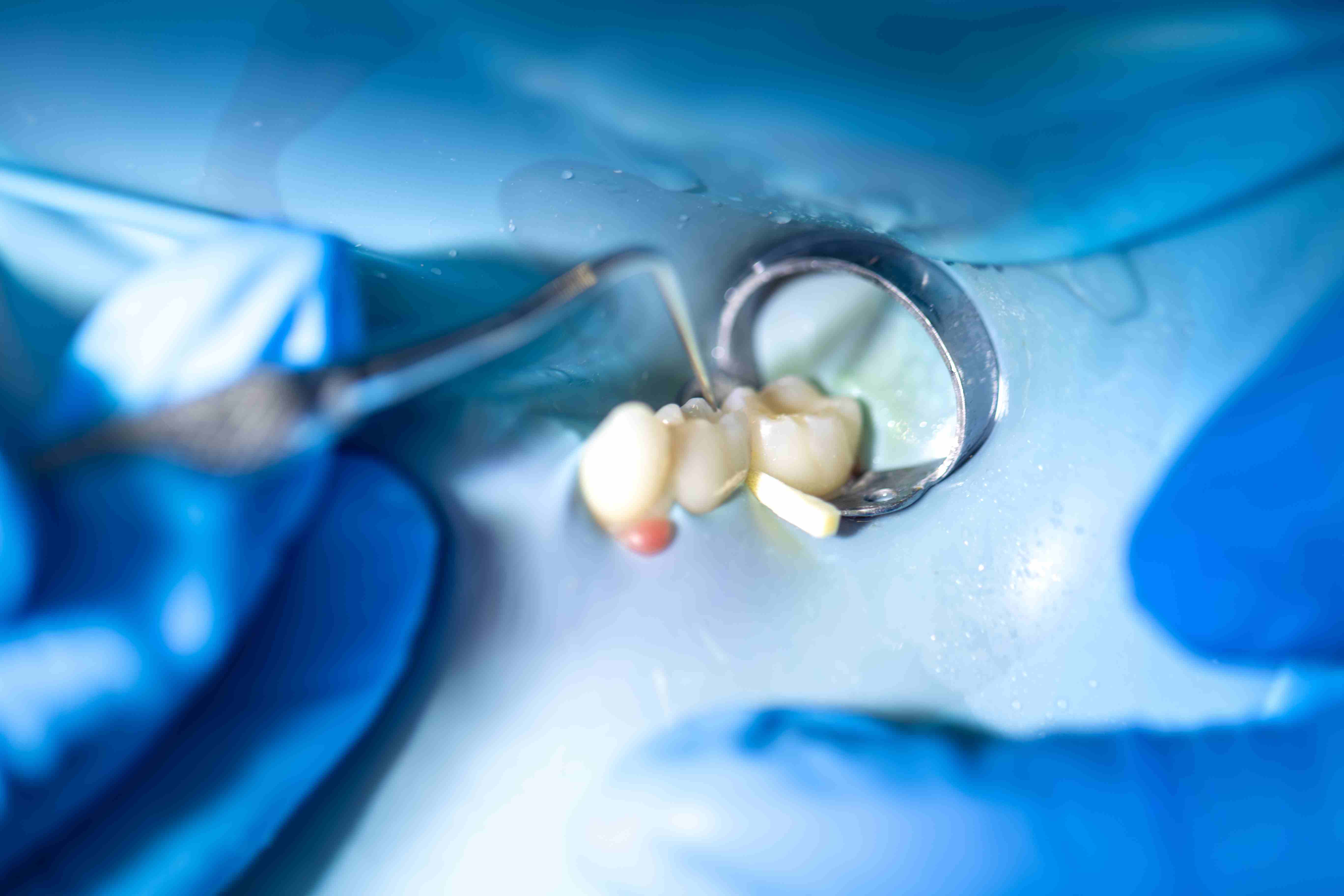 What is Filling & Restorative Dentistry