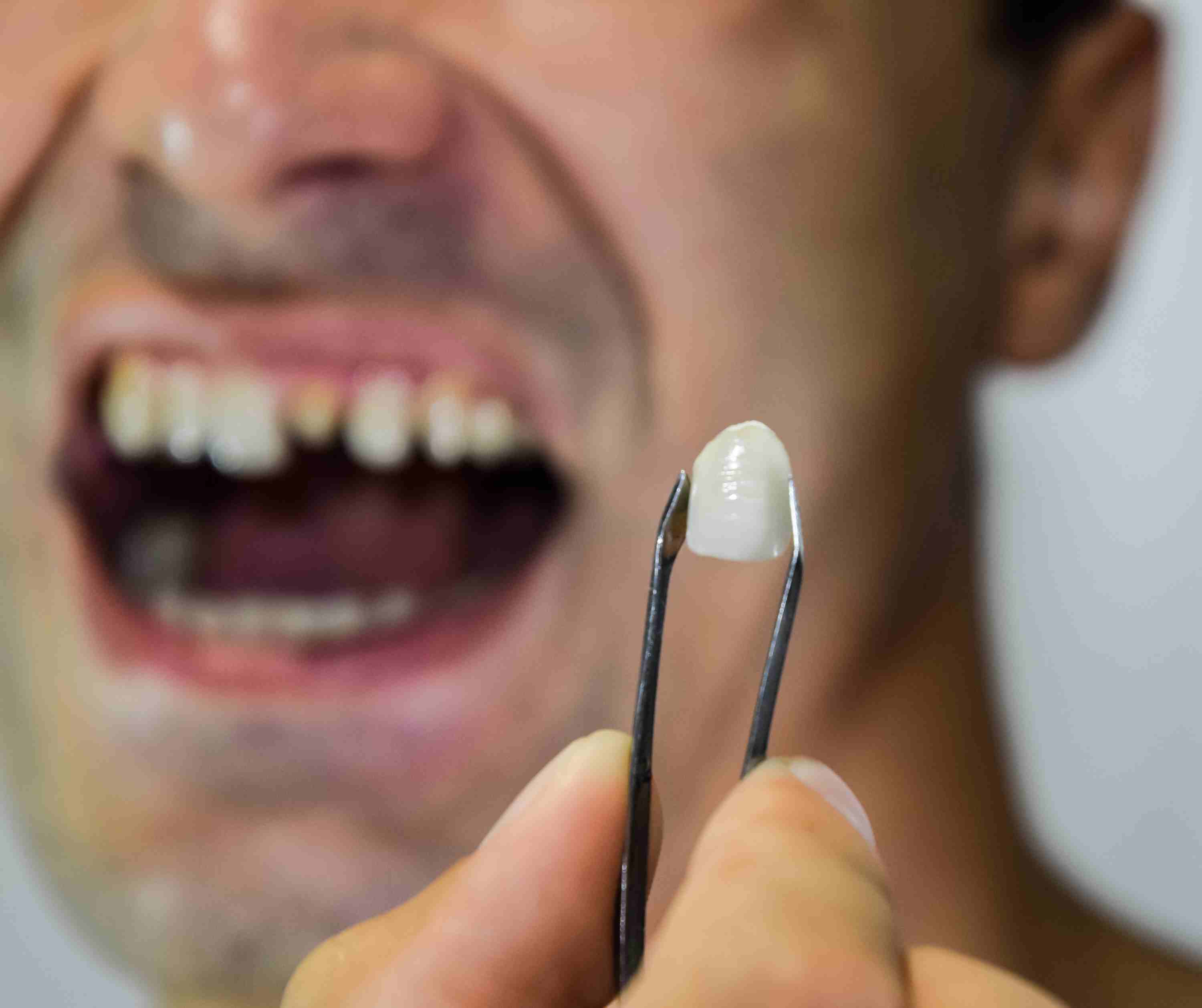 Common Filling & Restorative Dentistry Procedures