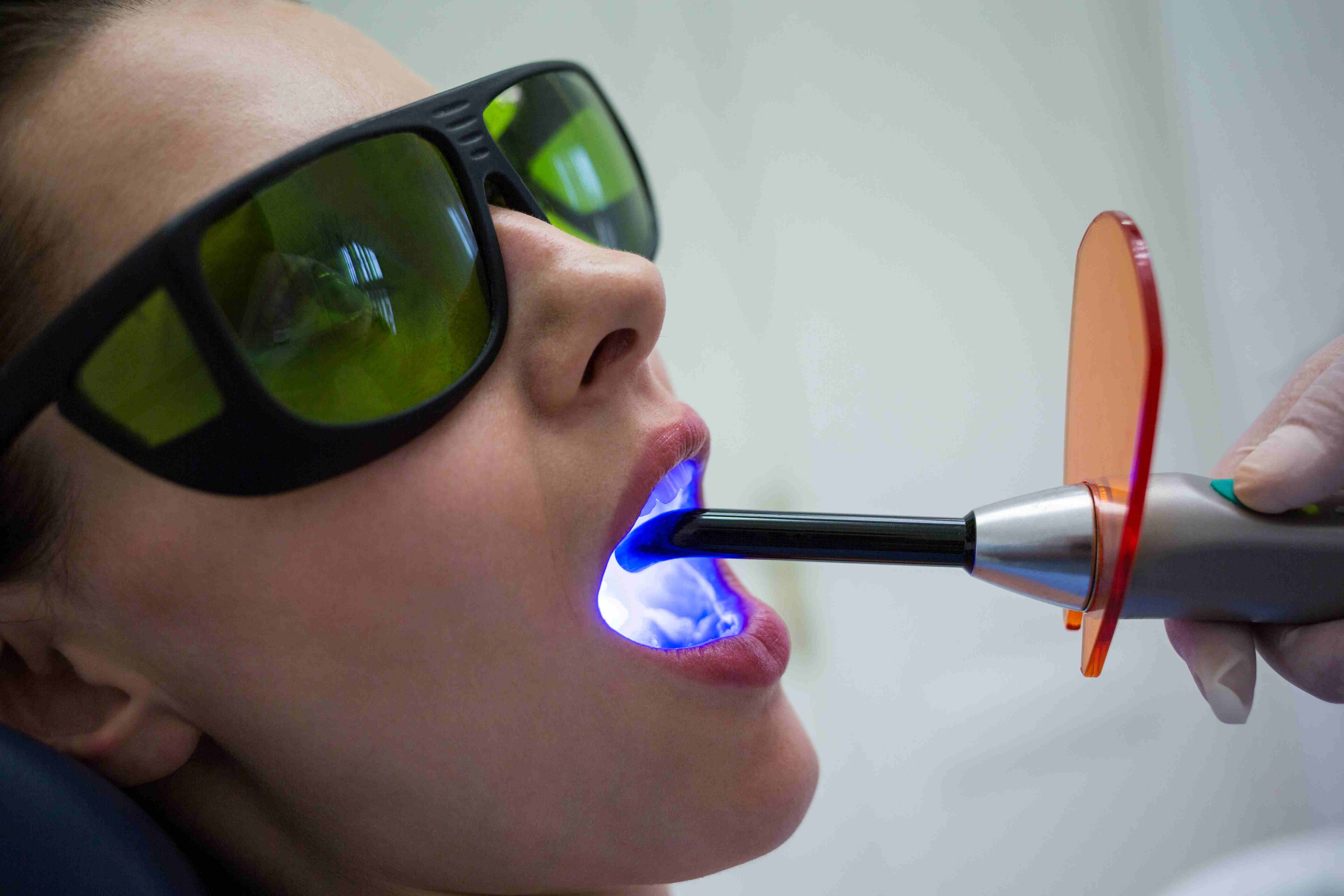What is Laser Whitening?