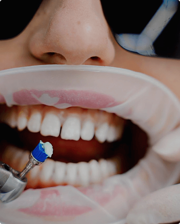 Gum treatment procedure