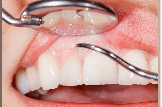 Advanced gum treatment