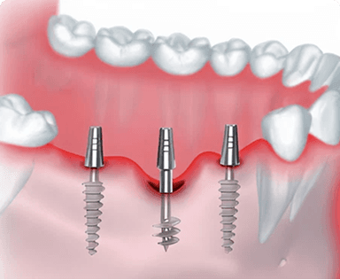 Cortical dental implant model