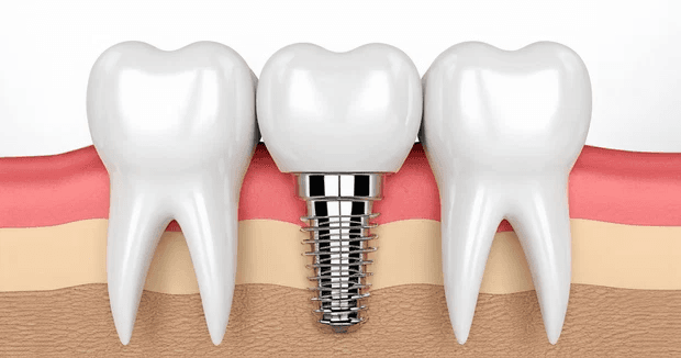Cortico-Basal Implants
