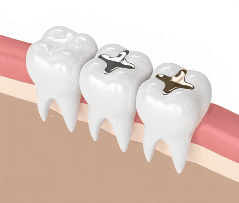 Dental fillings