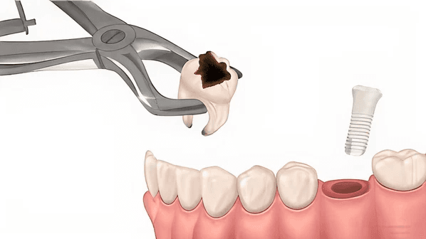 Immediate implants