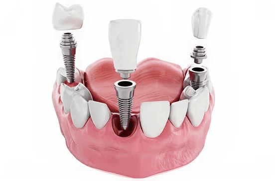 Implant dentistry