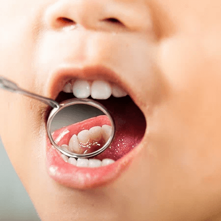 Kids root canal treatment