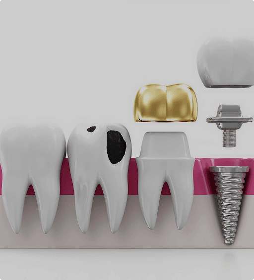 Root canal treatment