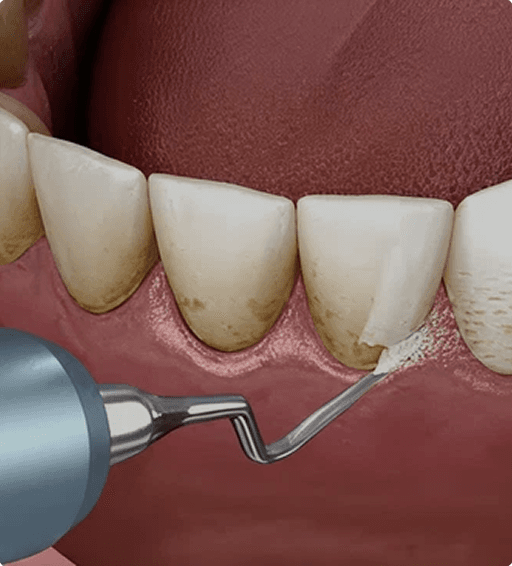 Ultrasonic scaling