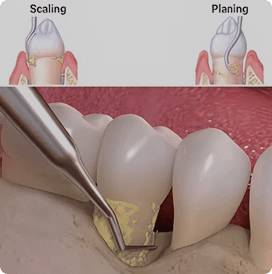 Teeth polishing