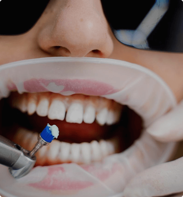 Scaling and cleaning benefits