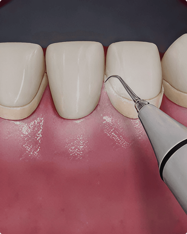 Scaling and cleaning procedure