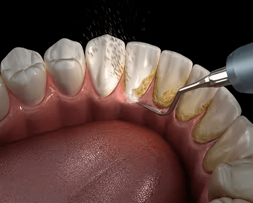 Dental scaling and cleaning