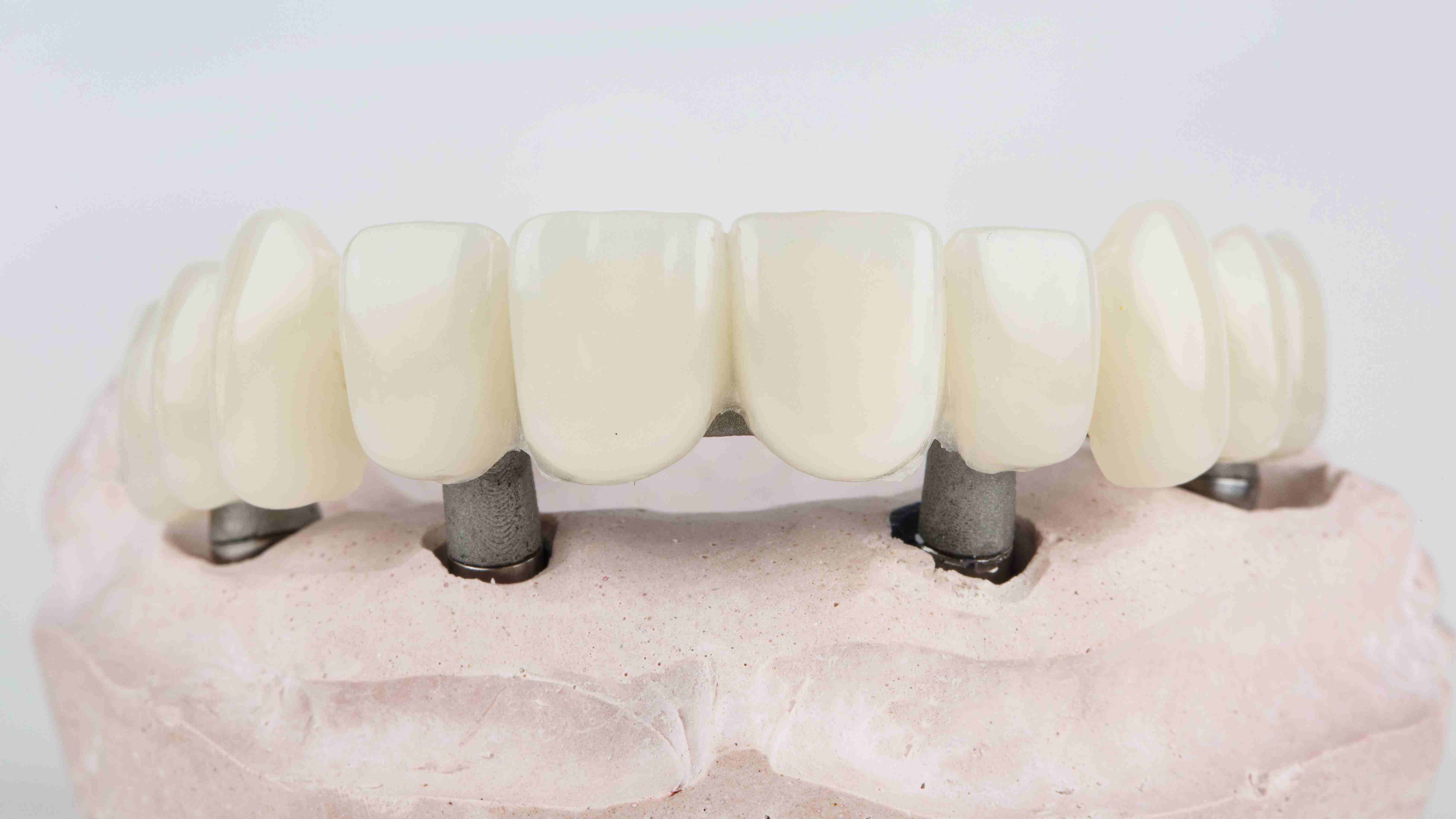 Common Prosthodontic Procedures