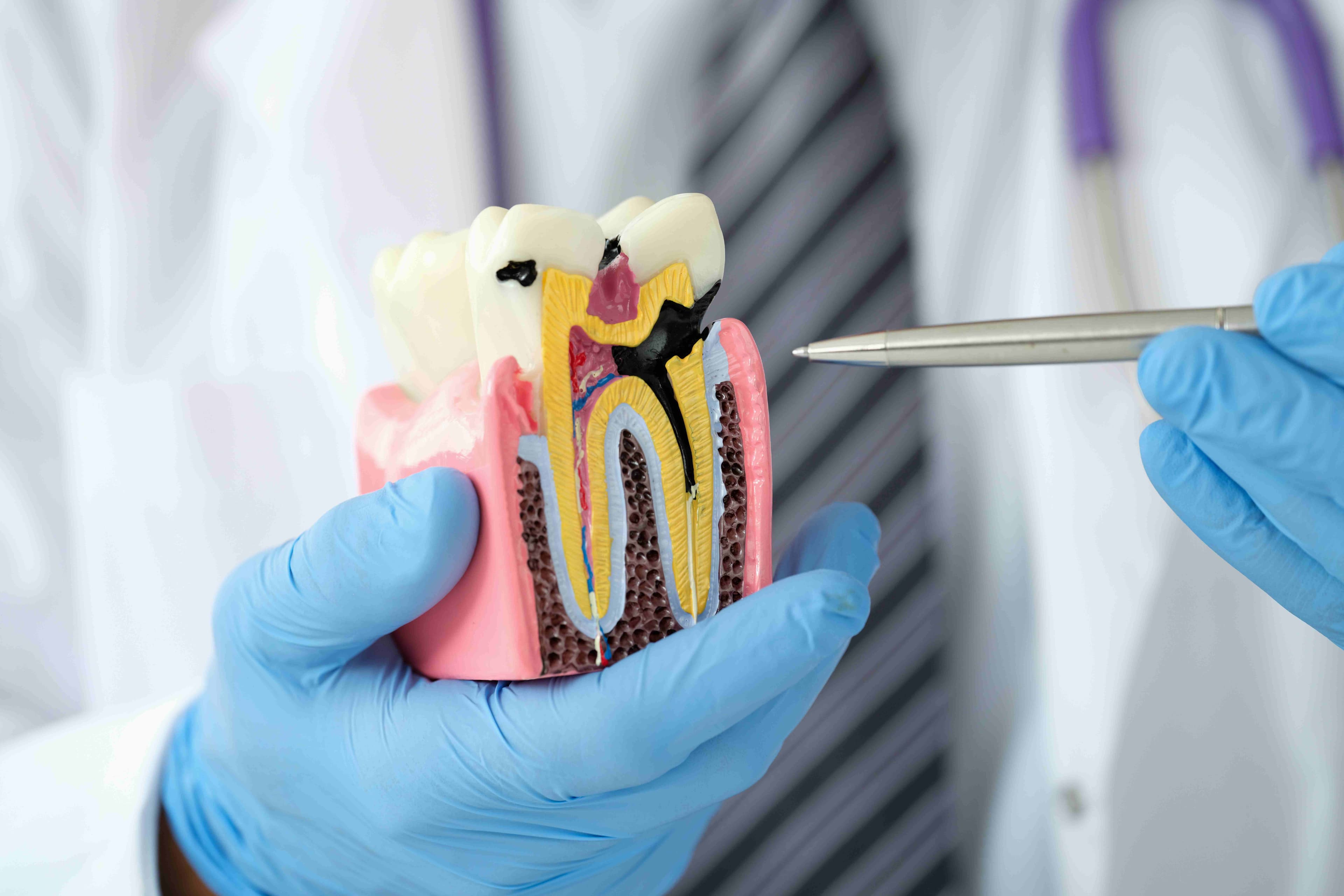 Who Needs Root Canal Treatment?