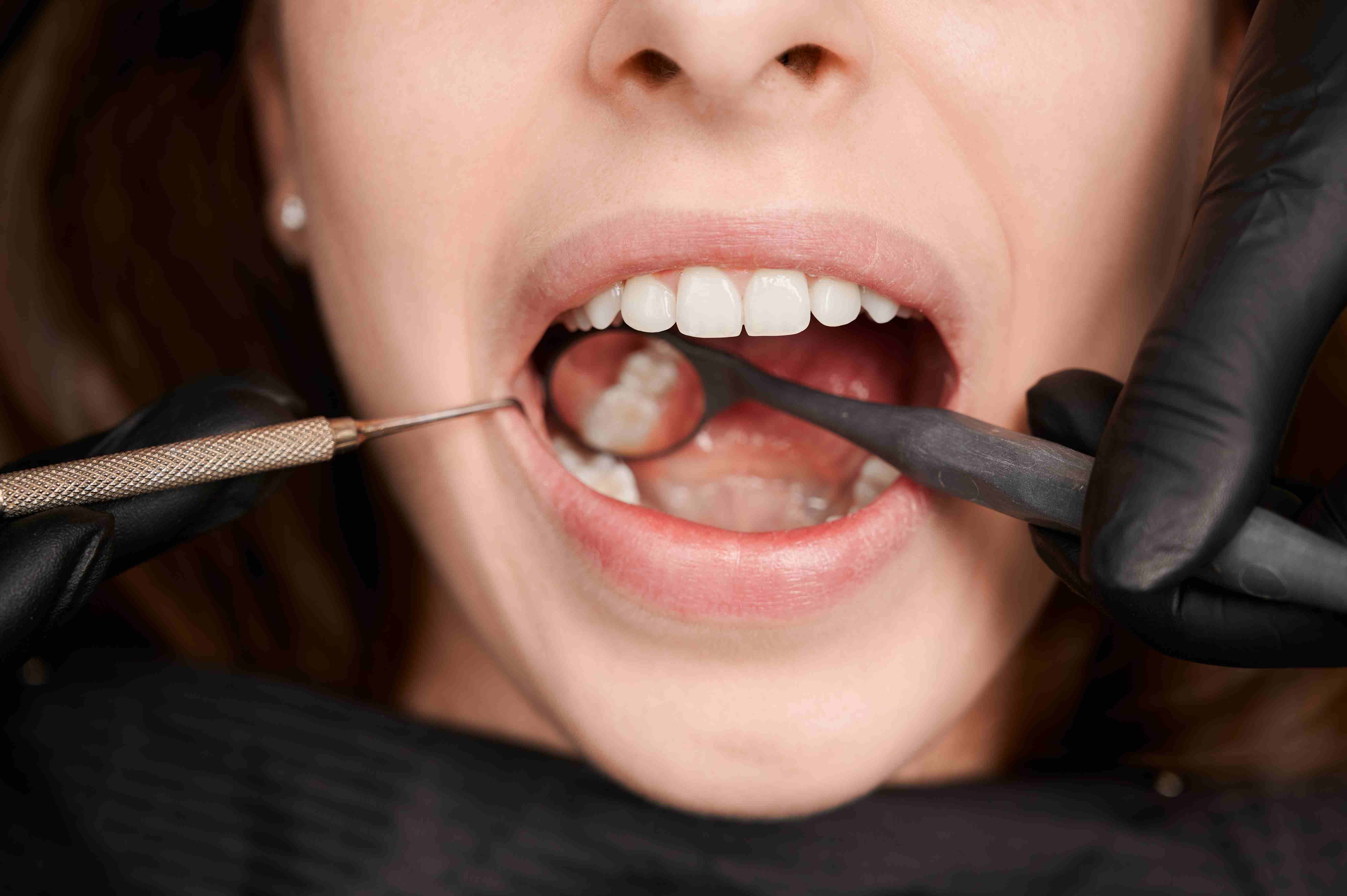 What Is Tooth Extraction