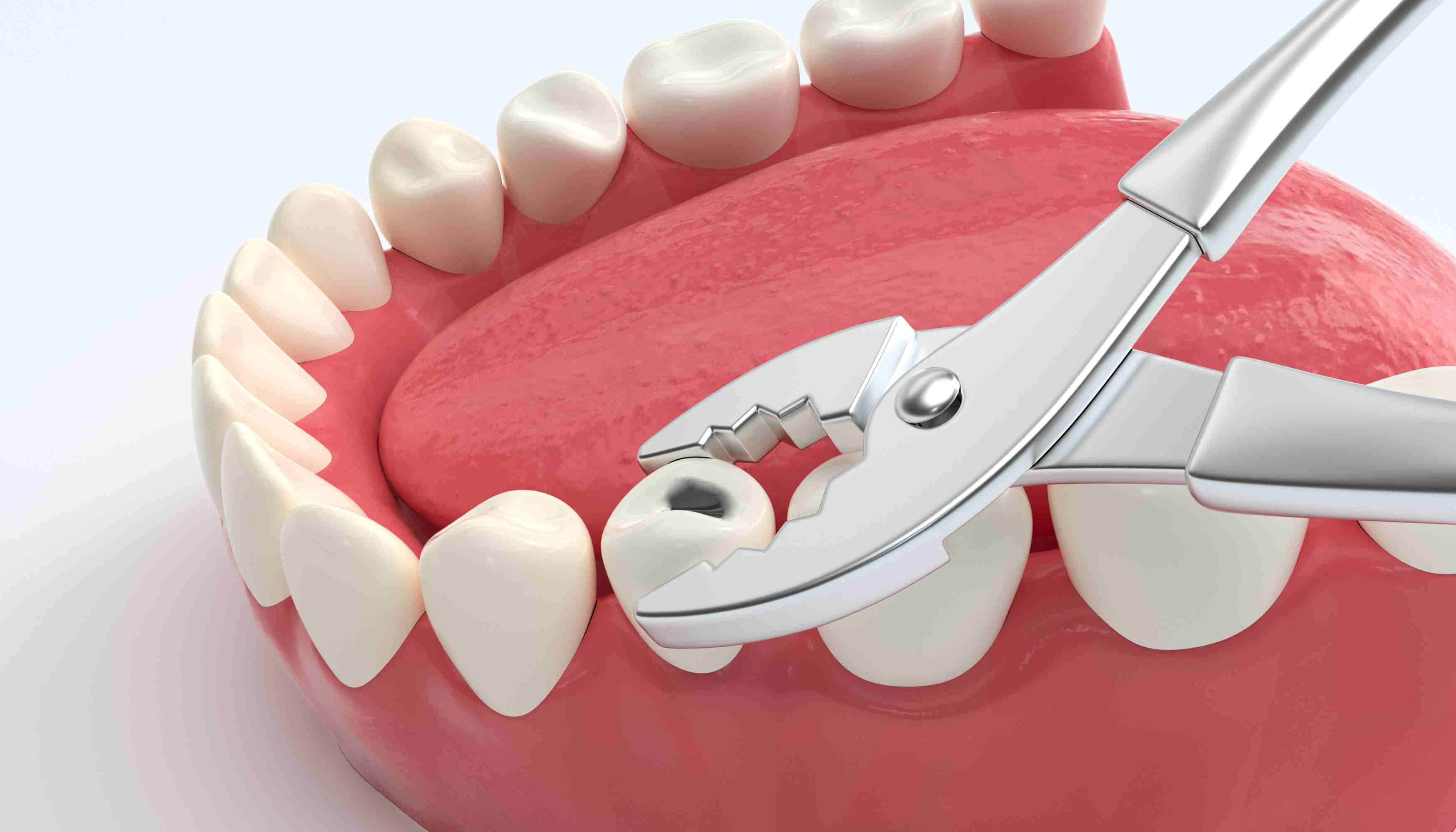 Benefits of Tooth Extraction