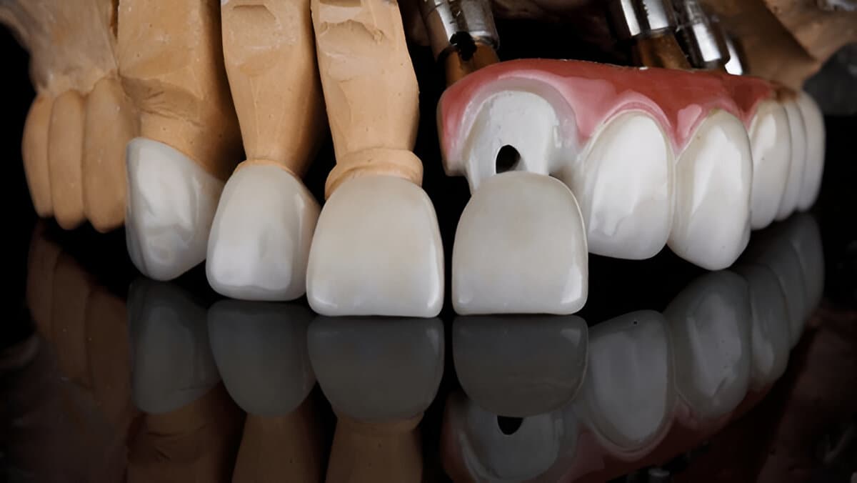 What Are Veneers?