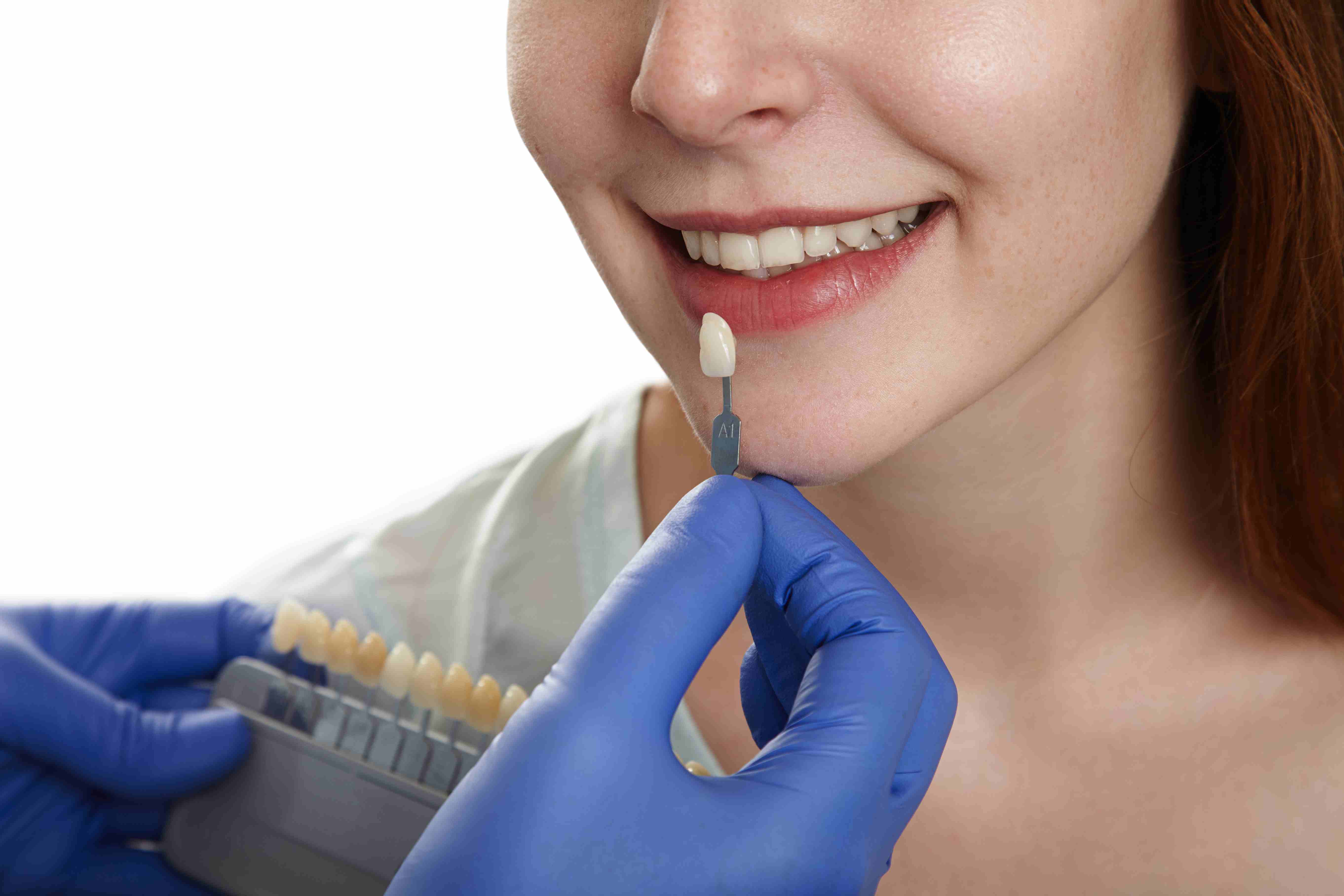 What Are Veneers?
