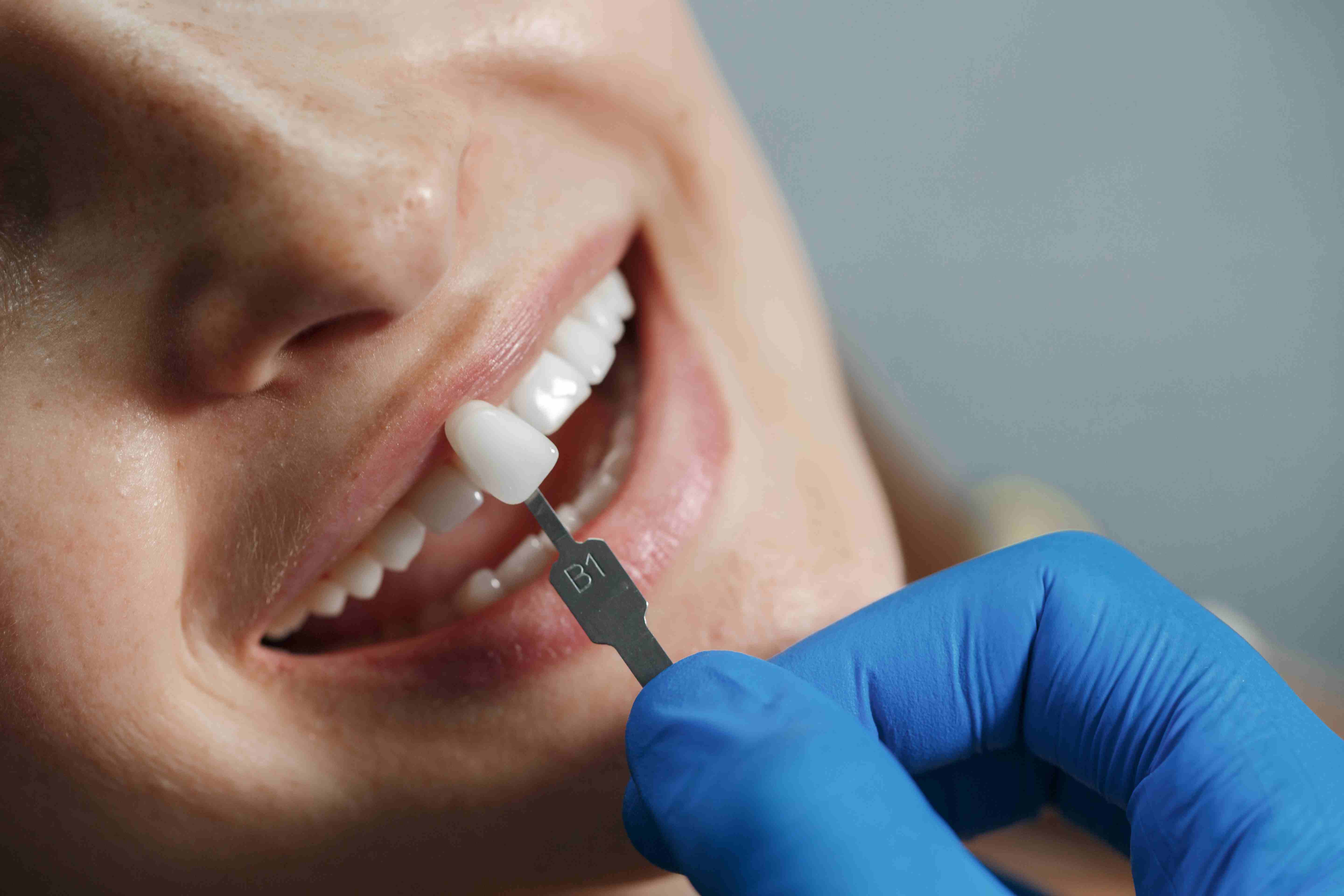 Benefits of Veneers