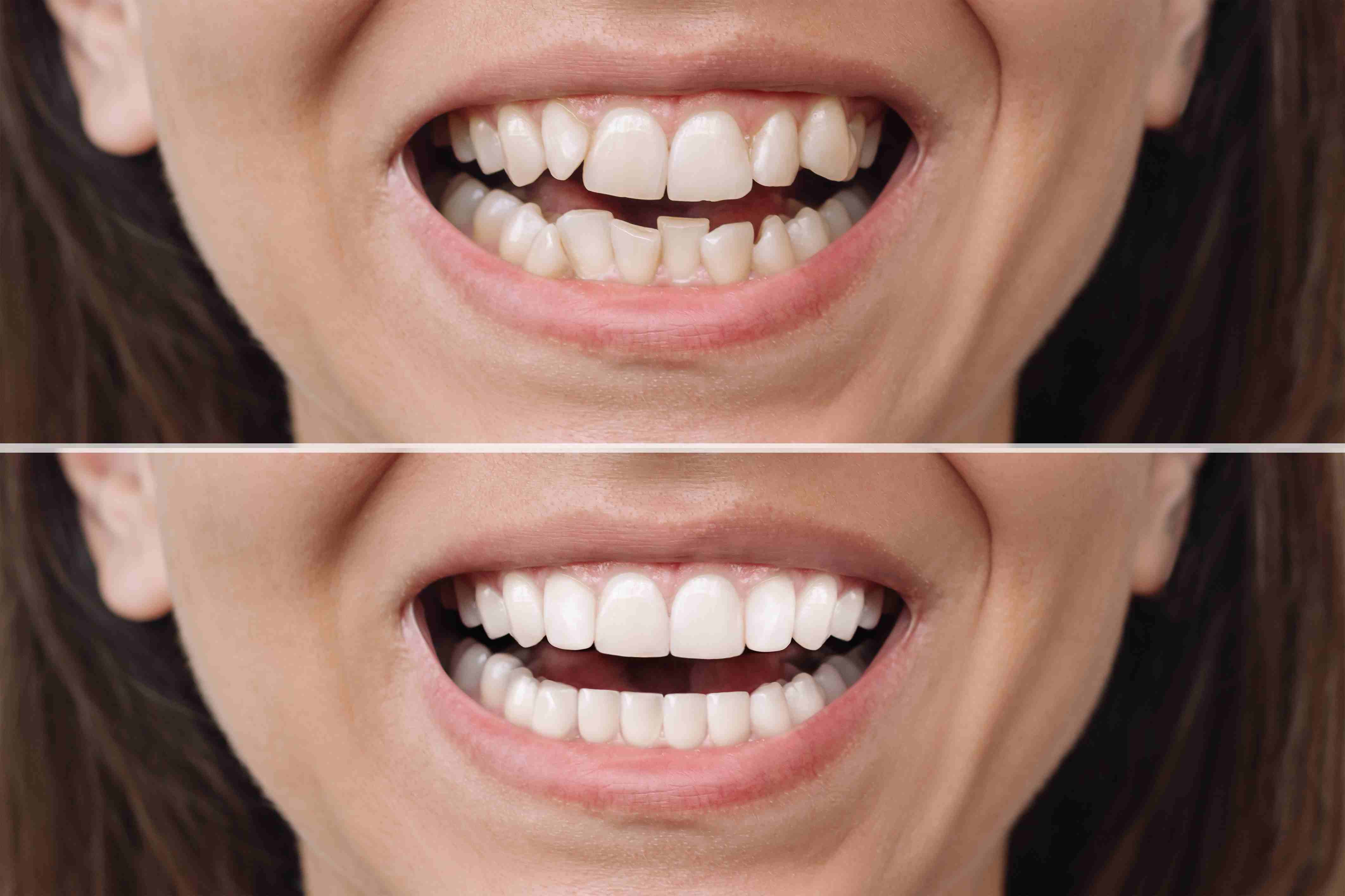 The Veneer Process