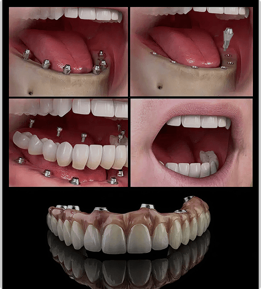 Cortical implant placement