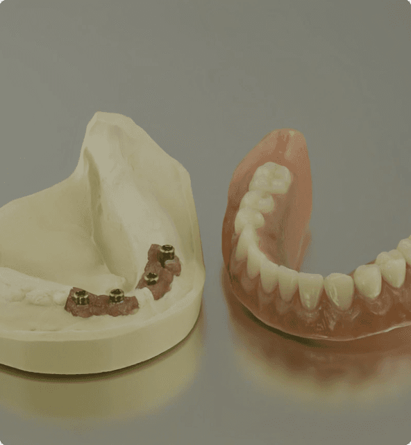 Dental model showing implant placement