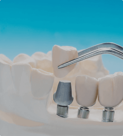 Cortico-basal implant