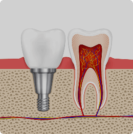Basal implant placement