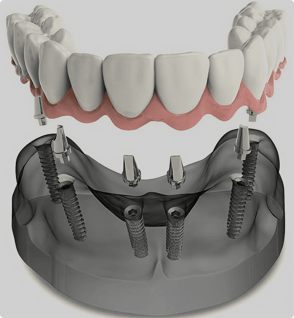 Dental model showing basal implant