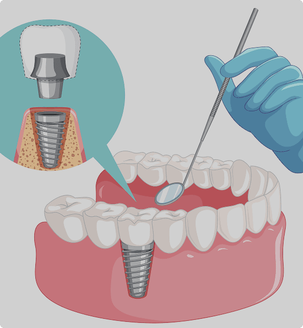 Cortico-basal implant benefits