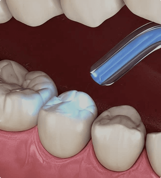 Composite filling