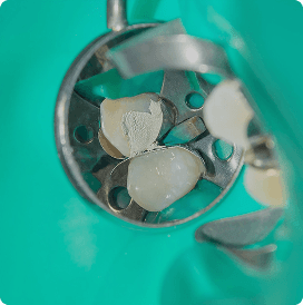 Cavity restoration