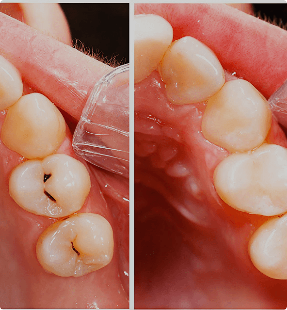 Tooth decay examination