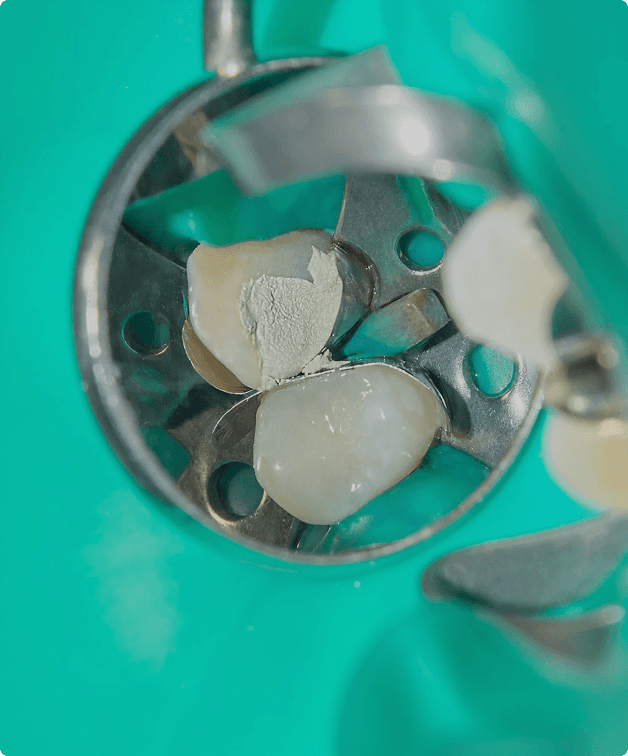 Dental filling procedure