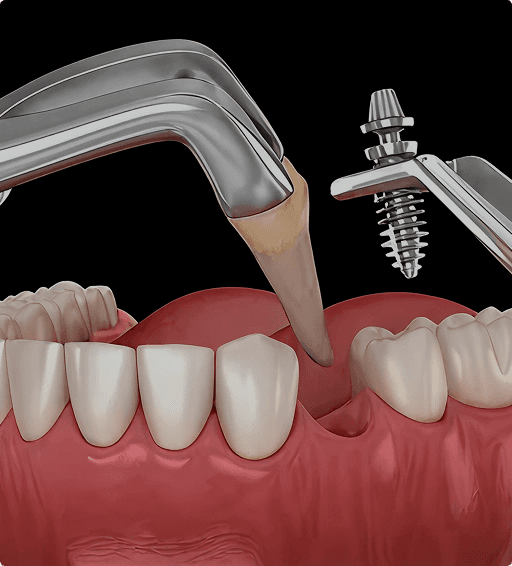 Tooth extraction and implant