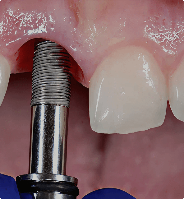 Implant consultation