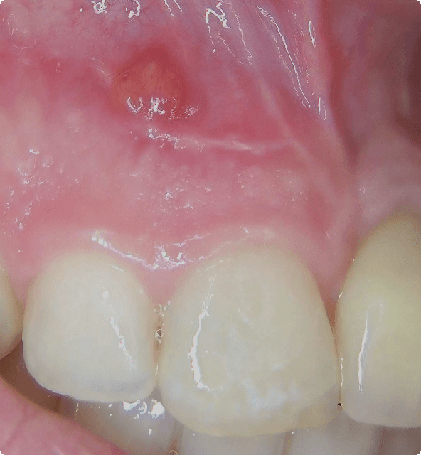 Immediate implant benefits