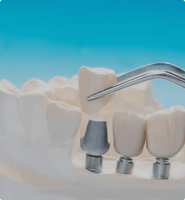 Implant assessment