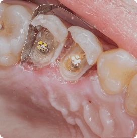 Root canal cleaning
