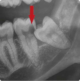 Impacted wisdom tooth