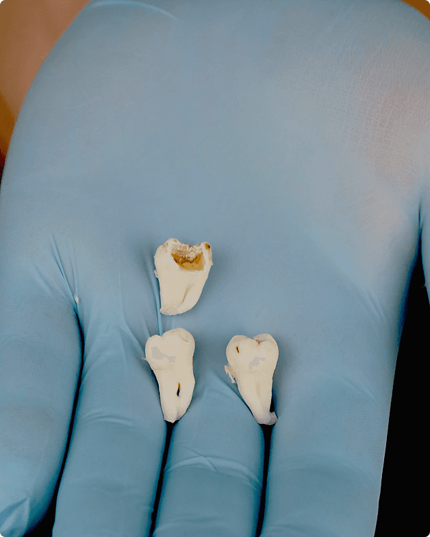 Wisdom tooth extraction procedure