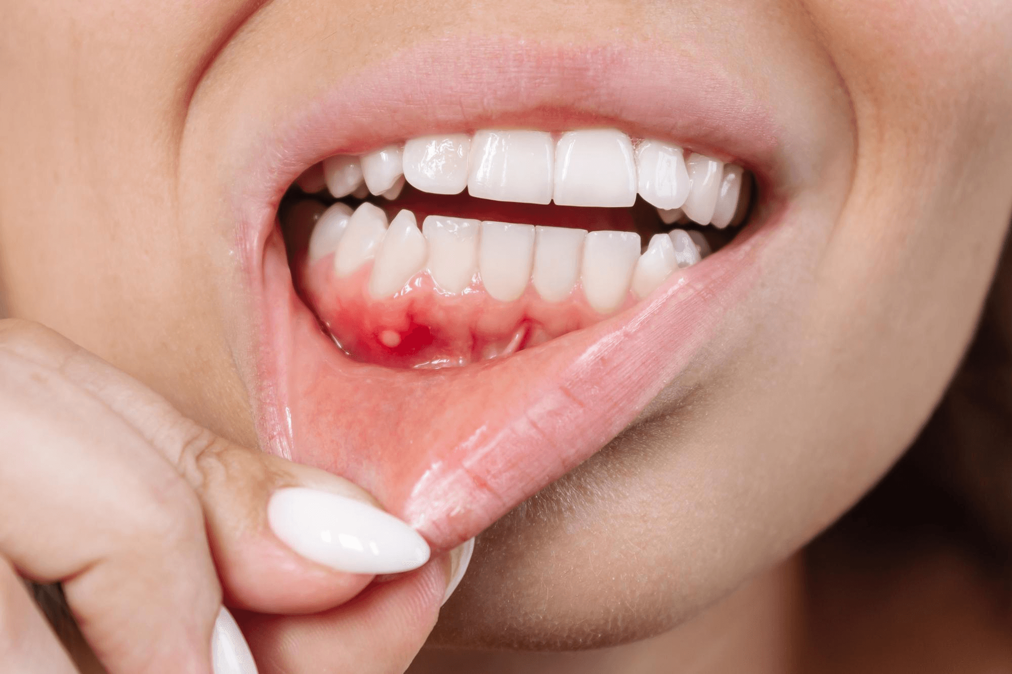 Swollen and tender gums.