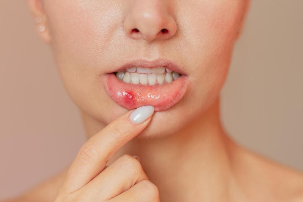 A woman highlights an ulcer spot on her lower lip.