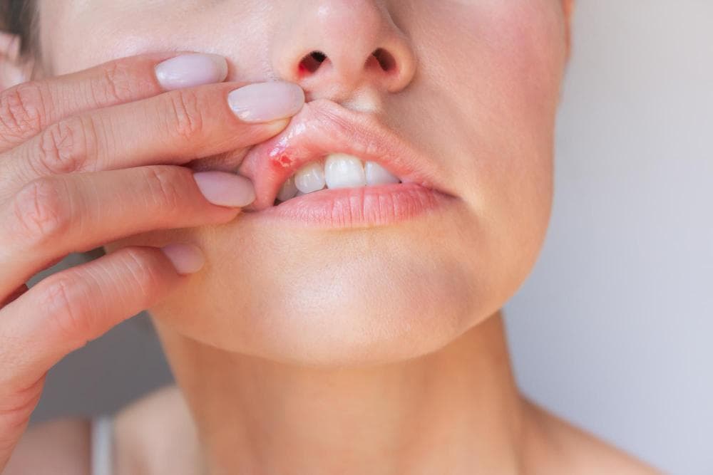 A woman points to an ulcer on her lip.