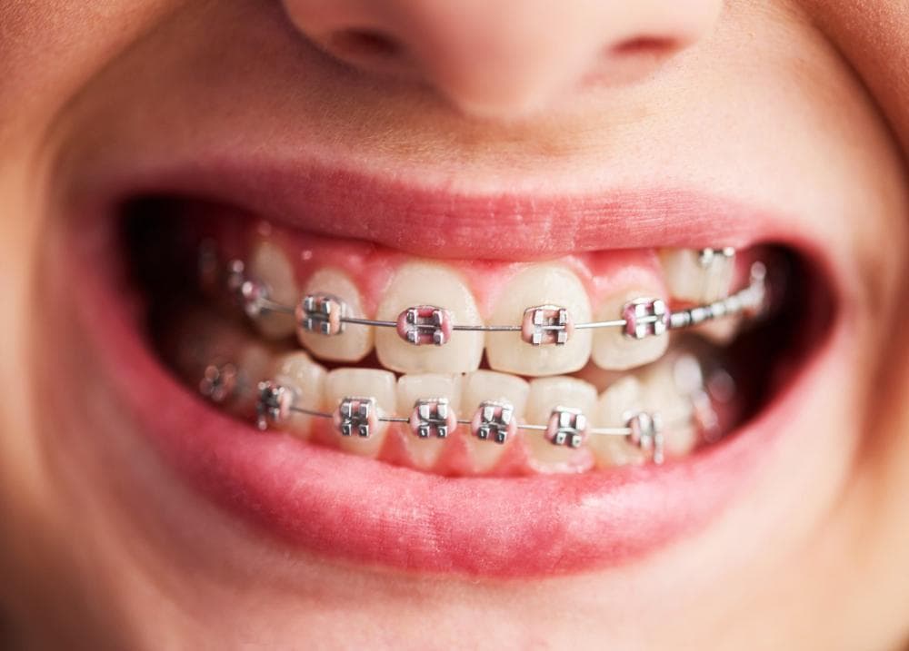 A close-up of a person’s mouth displaying their teeth with braces. The image focuses on the metallic brackets and wires of the braces, with the lips slightly parted to reveal a smile.