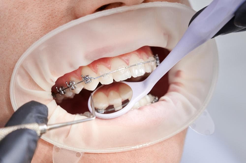 A close-up view of a patient's mouth during an orthodontic check-up. The mouth is open, revealing teeth with braces. A dental tool is being used by the orthodontist, and a clear plastic dental shield is placed over the gums to protect them during the procedure.